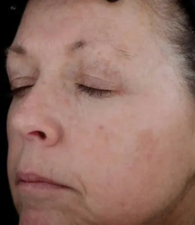 Intense Pulsed Light IPL photofacial Every Body is Unique at LHR Skin and Vein Center in Rochester, MI