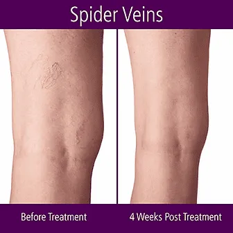 Spider Vein Removal, Vein Therapy, where Every Body is Unique at LHR Skin and Vein Center in Rochester, MI